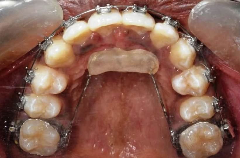 After Braces