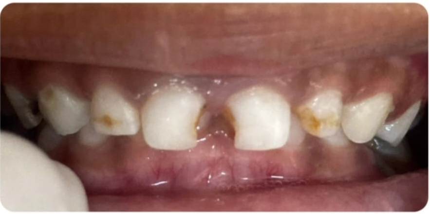 Before Milk Teeth Restoration