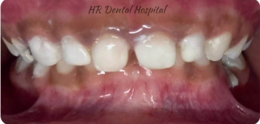 After Milk Teeth Restoration