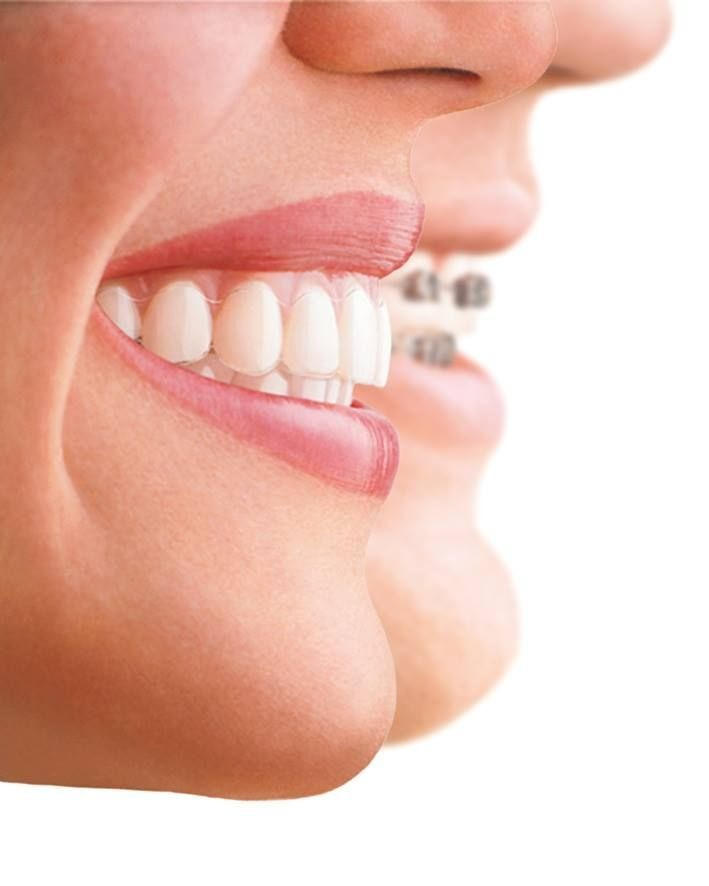 Aligners