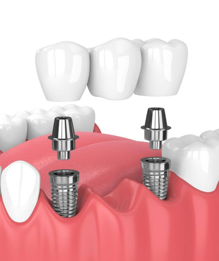 Implants