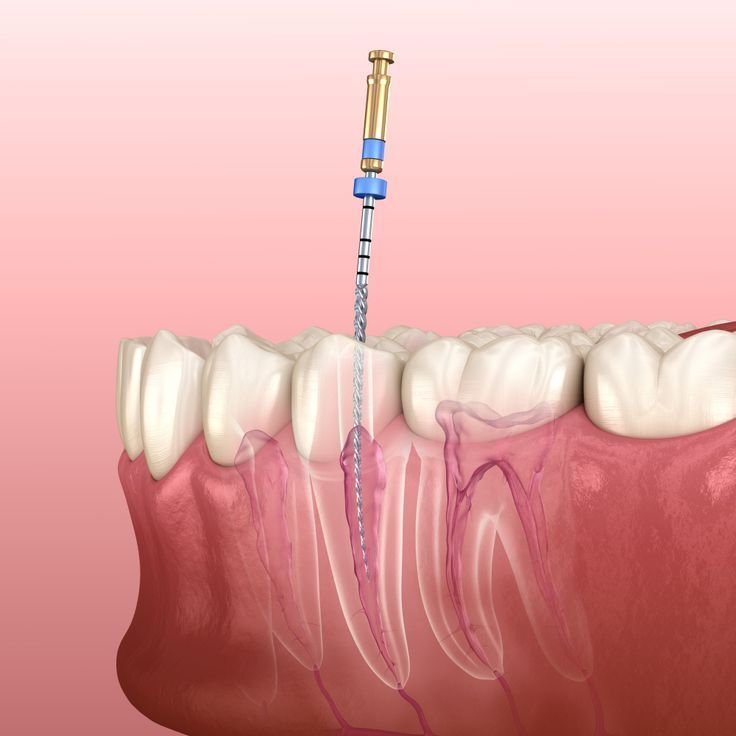Root Canal
